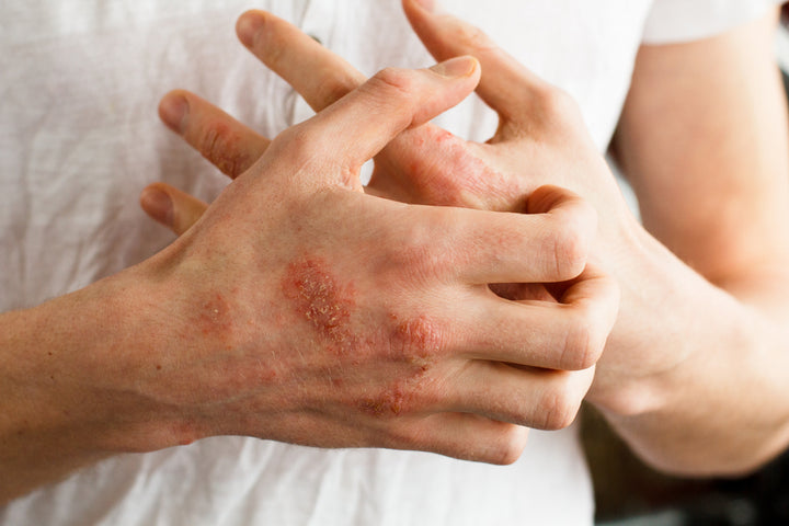 Customer Experience: Barrier Skin Cream Helps Man with Severe Eczema